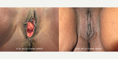 Case 7744 - 45-54 year old woman treated with Vaginoplasty