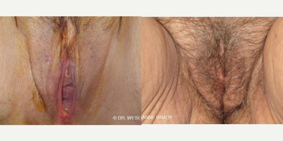 Case 7746 - 55-64 year old woman treated with Vaginoplasty