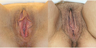 Case 7747 - 38 year old woman treated with Vaginoplasty
