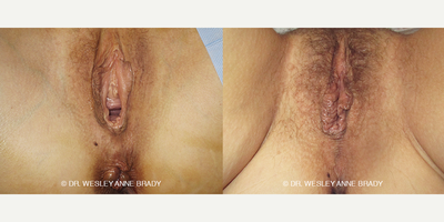 Case 7748 - 51 year old woman treated with a Vaginoplasty