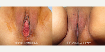 Case 7749 - 47 year old woman treated with Vaginoplasty