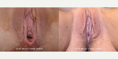 Case 7750 - 46 year old woman treated with Vaginoplasty