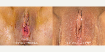 Case 7751 - 40 year old woman treated with Vaginoplasty