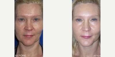 Case: 7791 - before and after photo of Woman treated with Facelift, CO2 Laser, Eyelid Surgery by Raymond E. Lee, MD
