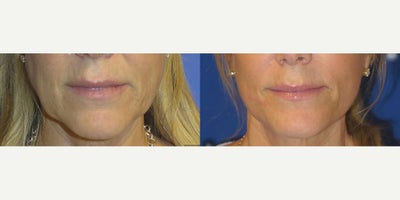 Case: 7792 - before and after photo of Woman treated with Facelift by Raymond E. Lee, MD