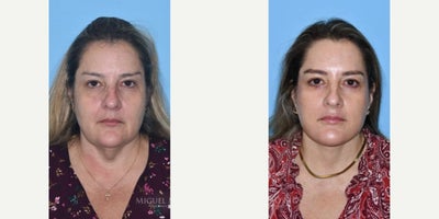 Case: 7793 - before and after photo of Woman treated with Facelift by Miguel Mascaro, MD