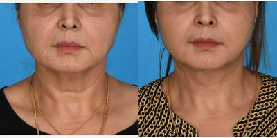 Case: 7794 - before and after photo of 55-64 year old woman treated with Facelift, Mini Facelift, SMAS Facelift, Lower Facelift, Neck Lift, Deep Plane Facelift by John L. Burns Jr., MD