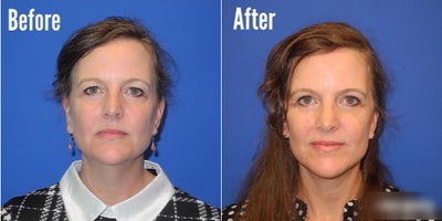 Case: 7795 - before and after photo of Woman treated with Facelift by Shahram Salemy, MD, FACS