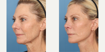Case: 7796 - before and after photo of 55-64 year old woman treated with Facelift, Rhinoplasty by Paul E. Chasan, MD, FACS
