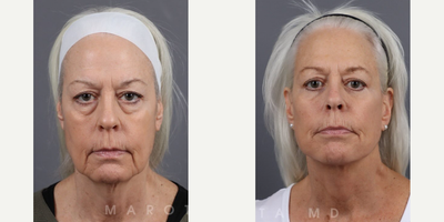 Case: 7797 - before and after photo of Woman treated with Deep Plane Facelift, Facelift, Neck Lift, Facial Fat Transfer, Eyelid Surgery by James C. Marotta, MD