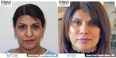 Case: 7798 - before and after photo of 45-54 year old woman treated with Facelift, Mini Neck Lift, Double Eyelid Surgery, Facial Fat Transfer by Hayati Akbas, MD