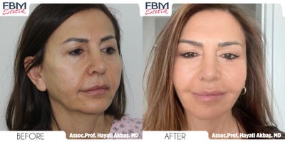 Case: 7799 - before and after photo of 45-54 year old woman treated with Facelift, Eyelid Surgery by Hayati Akbas, MD