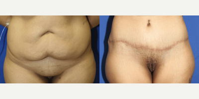 Case 78 - Woman treated with Tummy Tuck