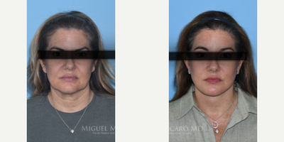 Case 7801 - Woman treated with Facelift