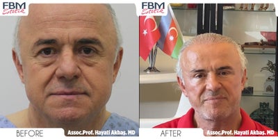 Case 7802 - 55-64 year old man treated with Deep Plane Facelift, Brow Lift, Facelift, Facial Fat Transfer