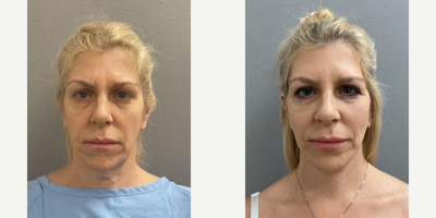 Case 7803 - 55 year old woman treated with NaturalLift