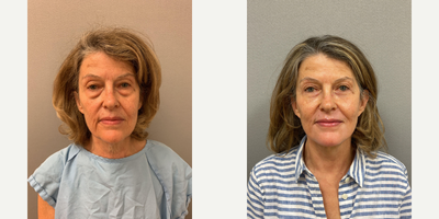 Case 7804 - 65 year old woman treated with NaturalLift, Eyelid Surgery