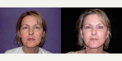 Case 7806 - Woman treated with Facelift