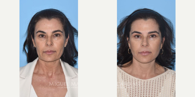 Case 7808 - 54 year old woman treated with Facelift