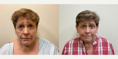 Case 7809 - Woman treated with Facelift, Eyelid Surgery