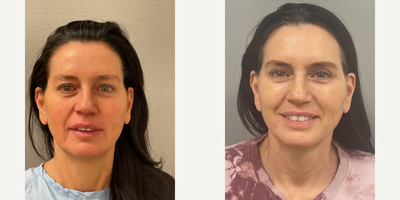 Case 7815 - 56 year old woman treated with NaturalLift, Upper Eyelid Blepharoplasty, Fat Transfer Cheeks, Laser Lower Eyelids