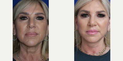 Case 7816 - 55-64 year old woman treated with Facelift