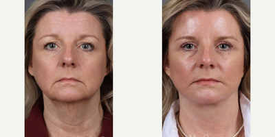 Case 7818 - Woman treated with Facelift, Eyelid Surgery