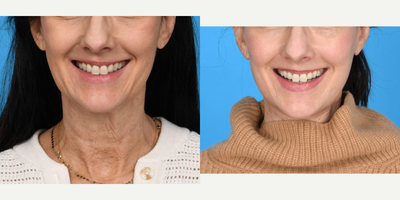 Case 7819 - 55-64 year old woman treated with Facelift, Neck Lift