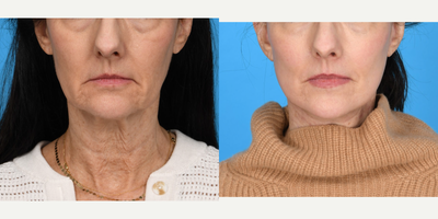 Case 7820 - 55-64 year old woman treated with Facelift, Neck Lift