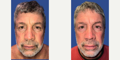 Case 7821 - Woman treated with Facelift