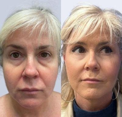 Case 7822 - Woman treated with Facelift