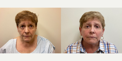 Case 7824 - Woman treated with Facelift, Eyelid Surgery