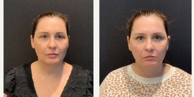 Case 7825 - 45-54 year old woman treated with Facelift