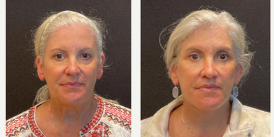 Case 7826 - 55-64 year old woman treated with Facelift