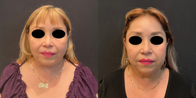 Case 7827 - 55-64 year old woman treated with Facelift