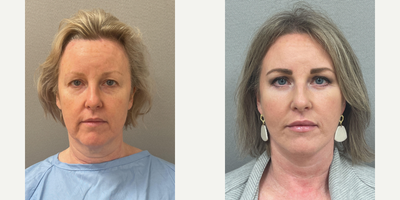 Case 7828 - 51 yo, NaturalLift, upper and lower eyelid blepharoplasty, fat transfer, and lower eyelids