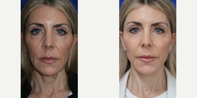 Case 7830 - 55-64 year old woman treated with Facelift, Neck Lift, Lip Lift