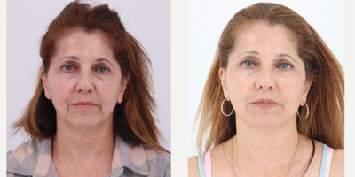 Case 7832 - 55-64 year old woman treated with Facelift, Neck Lift, CO2 Laser