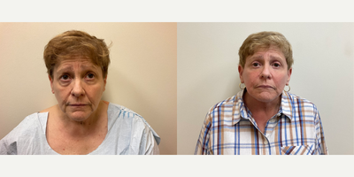 Case 7836 - Woman treated with Facelift, Eyelid Surgery