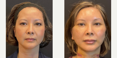Case 7838 - Deep plane facelift, deep plane neck lift, and upper lid blepharoplasty seen at one week