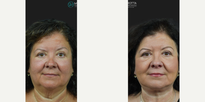Case 7841 - Woman treated with Deep Plane Facelift, Facelift