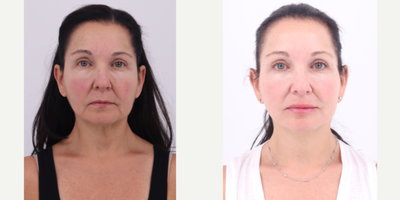 Case 7842 - 55-64 year old woman treated with Facelift, Neck Lift, Buccal Fat Removal