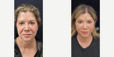 Case 7844 - Woman treated with Facelift