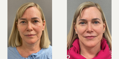 Case 7847 - 60 year old woman treated with NaturalLift, upper eyelid blepharoplasty