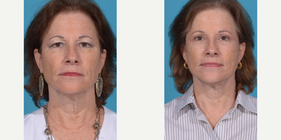 Case 7852 - 55-64 year old woman treated with Deep Plane Facelift, Eyelid Surgery, Facelift, Facial Fat Transfer, Lower Facelift, Mini Facel
