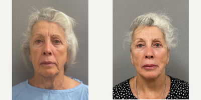 Case 7857 - 72 year old woman treated with NaturalLift, lower eyelid blepharoplasty