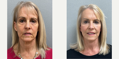 Case 7858 - 62 year old woman treated with NaturalLift, upper eyelid blepharoplasty