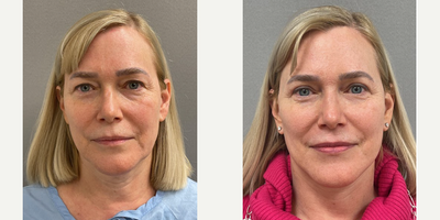 Case 7859 - 60 year old woman treated with NaturalLift, upper eyelid blepharoplasty