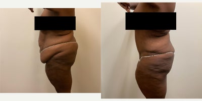 Case 786 - Woman treated with Tummy Tuck