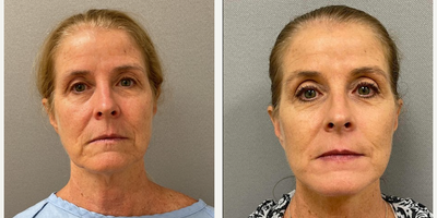 Case 7860 - 61 year old woman treated with NaturalLift